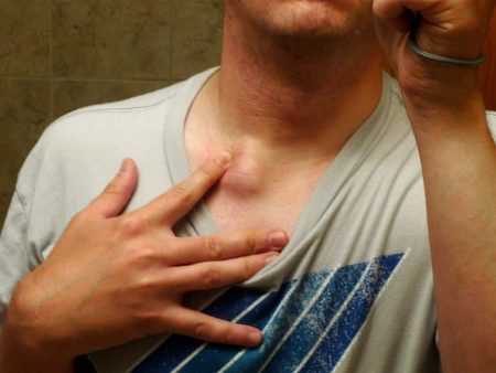 Ganglio inflamado cuello