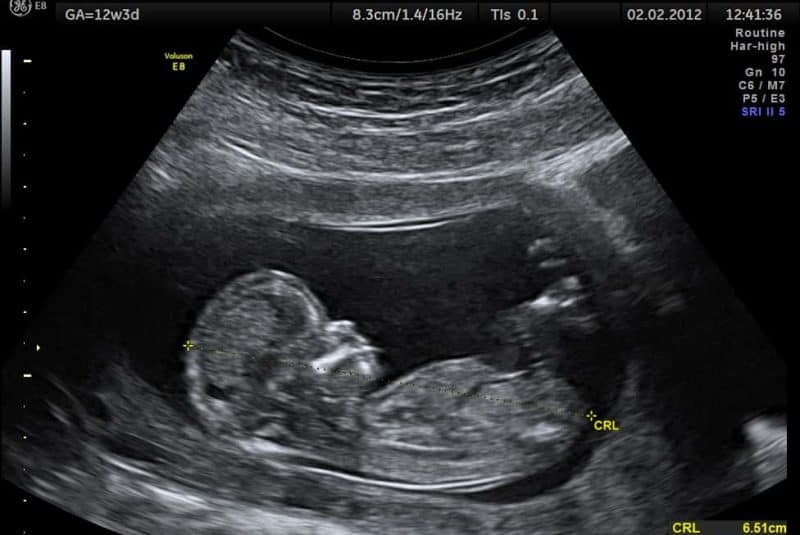 Ecografia de un feto de doce semanas
