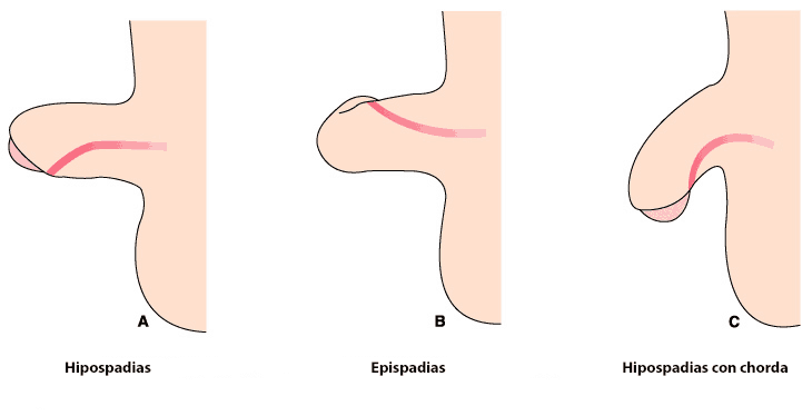 Malformaciones uretrales: Epispadias e hipospadias