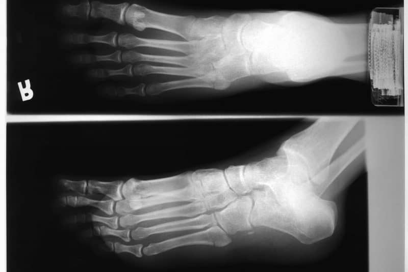Radiografía de Rayos X del pie
