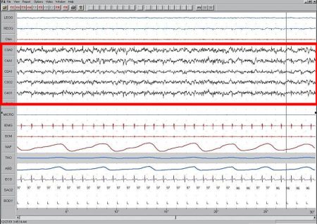EEG Sueño fase 1