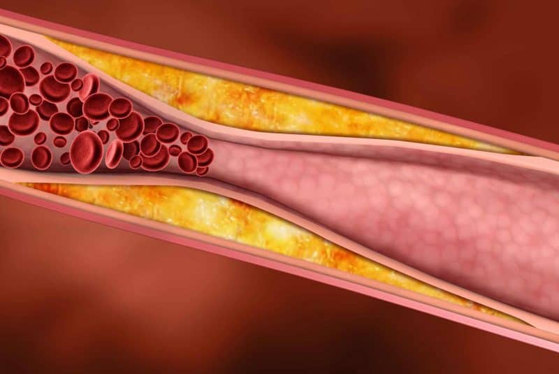 El colesterol malo forma placas de ateroma