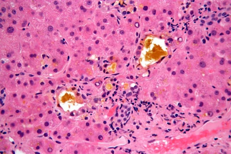 Micrografía colestasis