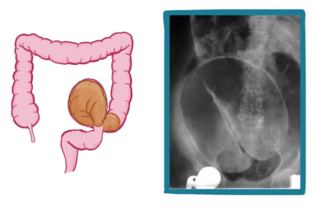 Vólvulo intestinal en rayos X