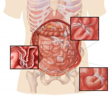 Adherencias abdominales en el intestino