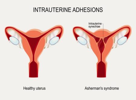 Síndrome de Asherman (adherencias intrauterinas)