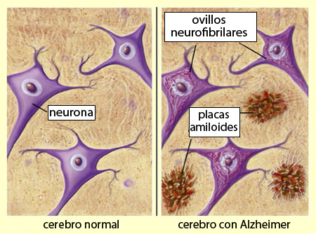 Cerebro con Alzheimer