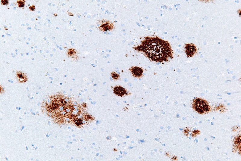 Placas seniles en angiopatía cerebral amiloide