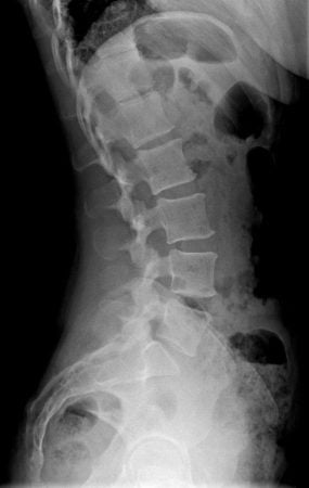 Radiografía de una hiperlordosis lumbar