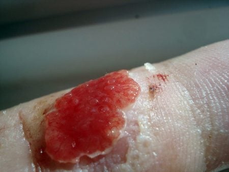 Tejido granular en la herida de un dedo